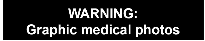 Graphic Photo of Hymenoplasty Surgery Warning Graphic Medical Photo